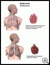 Thumbnail image of: Emphysema: Illustration