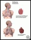 Thumbnail image of: Emphysema: Illustration