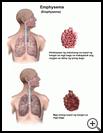 Thumbnail image of: Emphysema: Illustration