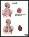 Thumbnail image of: Emphysema: Illustration