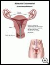 Thumbnail image of: Endometrial Ablation: Illustration
