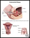 Thumbnail image of: Endometrial Biopsy: Illustration