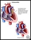 Thumbnail image of: Endocarditis Heart Infection: Illustration