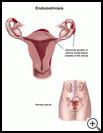 Thumbnail image of: Endometriosis: Illustration