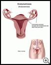 Thumbnail image of: Endometriosis: Illustration