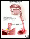 Thumbnail image of: Esophageal Dilation: Illustration