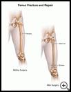 Thumbnail image of: Femur Fracture and Repair: Illustration
