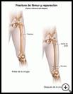 Thumbnail image of: Femur Fracture and Repair: Illustration