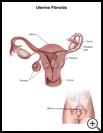 Thumbnail image of: Uterine Fibroids: Illustration