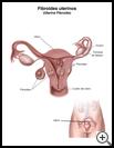 Thumbnail image of: Uterine Fibroids: Illustration