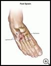 Thumbnail image of: Foot Sprain: Illustration