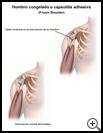 Thumbnail image of: Frozen Shoulder: Illustration
