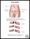 Thumbnail image of: Tubal Ligation: Illustration