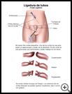 Thumbnail image of: Tubal Ligation: Illustration