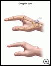 Thumbnail image of: Ganglion Cyst: Illustration
