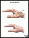 Thumbnail image of: Ganglion Cyst: Illustration