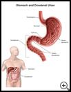 Thumbnail image of: Stomach and Duodenal Ulcer: Illustration