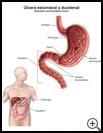 Thumbnail image of: Stomach and Duodenal Ulcer: Illustration