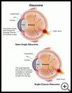Thumbnail image of: Glaucoma: Illustration