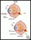Thumbnail image of: Glaucoma: Illustration