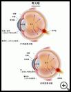 Thumbnail image of: Glaucoma: Illustration