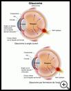 Thumbnail image of: Glaucoma: Illustration