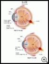 Thumbnail image of: Glaucoma: Illustration
