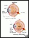 Thumbnail image of: Glaucoma: Illustration