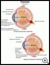 Thumbnail image of: Glaucoma: Illustration