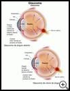 Thumbnail image of: Glaucoma: Illustration