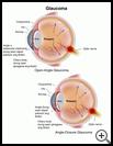 Thumbnail image of: Glaucoma: Illustration