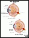 Thumbnail image of: Glaucoma: Illustration