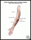 Thumbnail image of: Golfer's Elbow (Medial Epicondylitis): Illustration