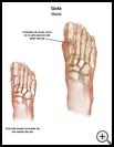 Thumbnail image of: Gout: Illustration