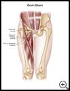 Thumbnail image of: Groin Strain: Illustration