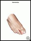 Thumbnail image of: Hammertoe: Illustration