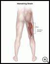 Thumbnail image of: Hamstring Strain: Illustration