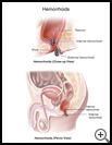 Thumbnail image of: Hemorrhoids: Illustration
