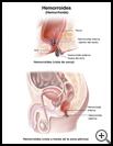 Thumbnail image of: Hemorrhoids: Illustration