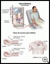 Thumbnail image of: Kidney Dialysis: Hemodialysis Illustration