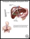 Thumbnail image of: Transjugular Intrahepatic Portosystemic Shunt: Illustration