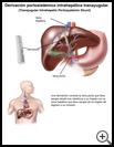 Thumbnail image of: Transjugular Intrahepatic Portosystemic Shunt: Illustration