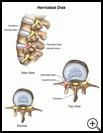 Thumbnail image of: Herniated Disk: Illustration