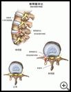 Thumbnail image of: Herniated Disk: Illustration