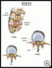 Thumbnail image of: Herniated Disk: Illustration