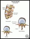 Thumbnail image of: Herniated Disk: Illustration