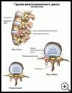 Thumbnail image of: Herniated Disk: Illustration