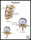 Thumbnail image of: Herniated Disk: Illustration