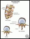 Thumbnail image of: Herniated Disk: Illustration