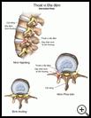 Thumbnail image of: Herniated Disk: Illustration